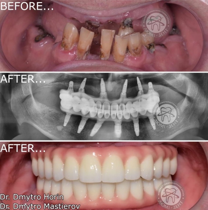 Ціна протезування зубів фото Люмі-Дент