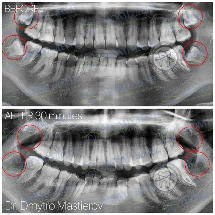 Зуб мудрости рентген фото Люми-Дент