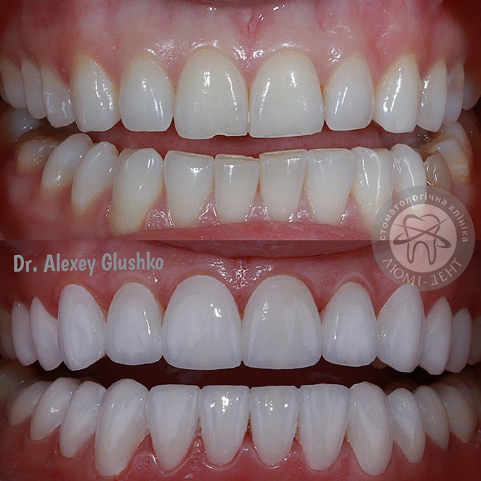 Художня реставрація зубів ціна фото Люмі-Дент