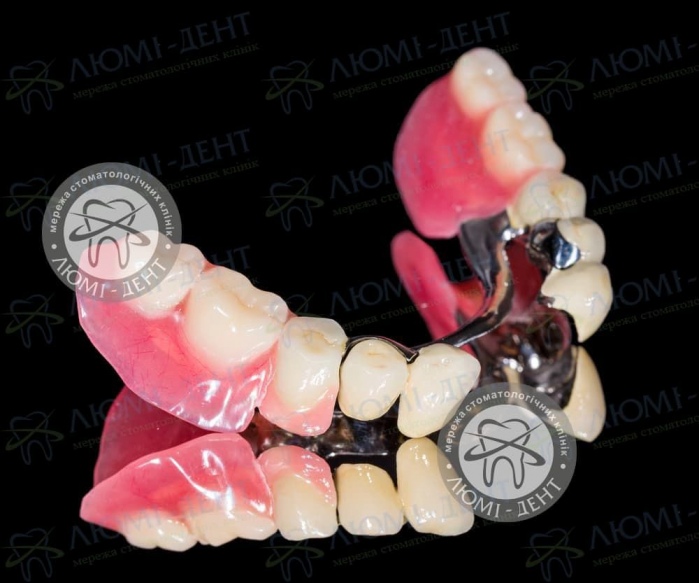 Знімне протезування зубів протези фото Люмі-Дент