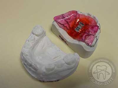 Пластинки на зуби для дітей ціна фото Люмідент