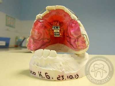 Пластинки на зуби ціна фото Люмі-Дент