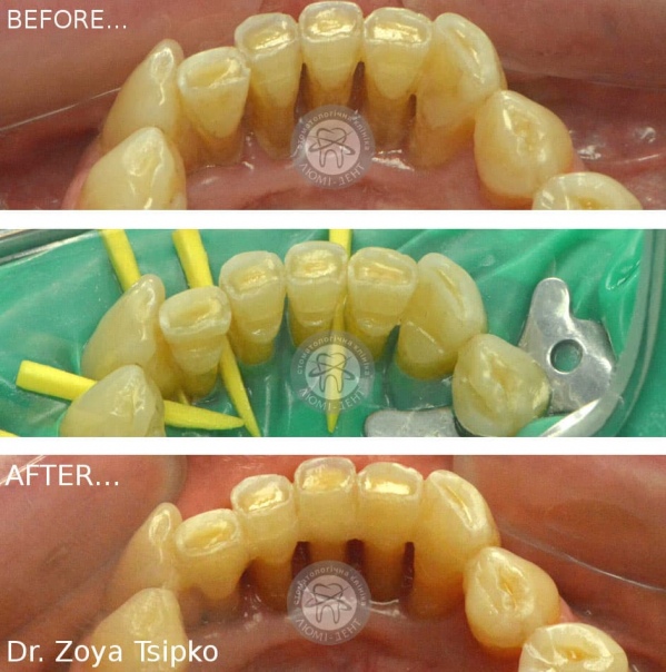 шинування зубів при пародонтиті фото Люмі-Дент