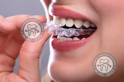 шинування зубів це фото Люмі-Дент
