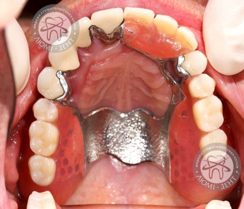 шинування зубів ціна фото Люмі-Дент