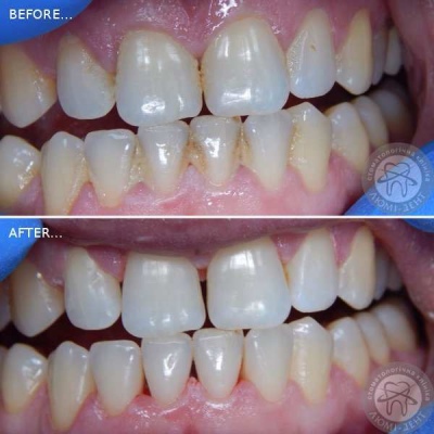 Ультразвуковая чистка зубов фото Люми-Дент