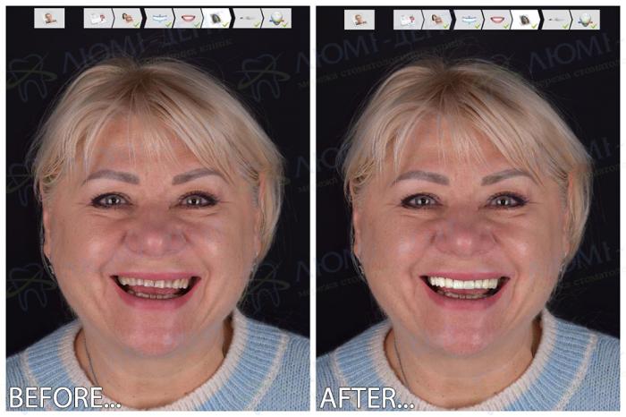 Digital Smile Design Digital Smile Design Люми-Дент
