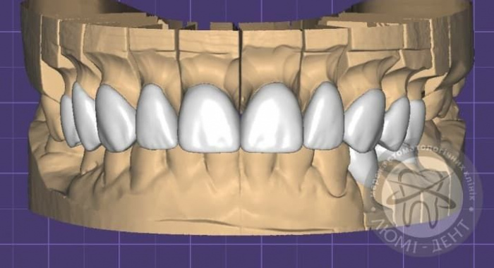 Як виглядають вініри на зубах фото Люмі-Дент