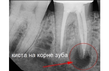 Резекція верхівки корня зуба фото Люмідент