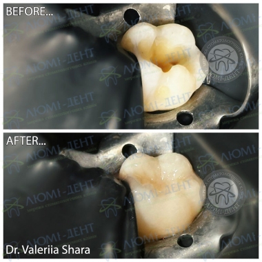 Пример работы врача стоматолога  Шары Валерии