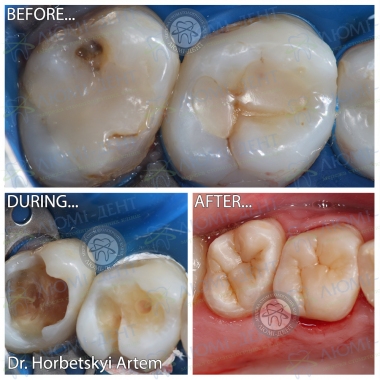Пример работы врача стоматолога терапевта Горбецкого Артема 
