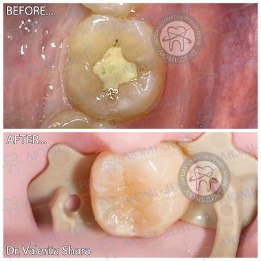 Пример работы врача стоматолога  Шары Валерии