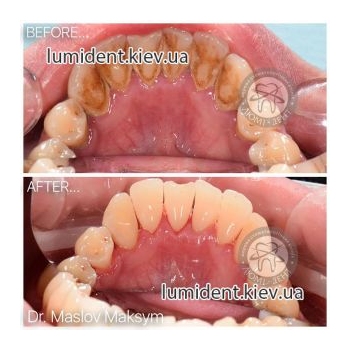 чистка зубів ультразвуком, фото, до і після
