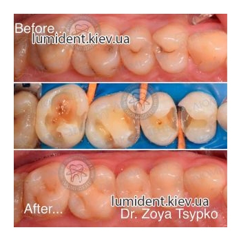 До і після пломбування зубів фото Люмідент