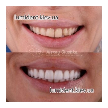 Виниры протезирование зубов Люми-Дент
