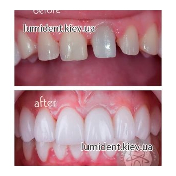 зубное протезирование фото Люмидент