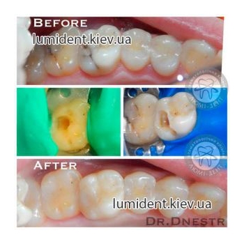 лечение зубов киев, фото, до и после
