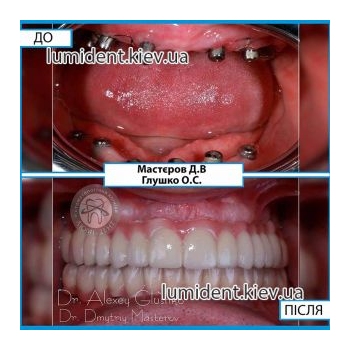 Implantation if there are no teeth on the jaws Kiev Lumi-Dent
