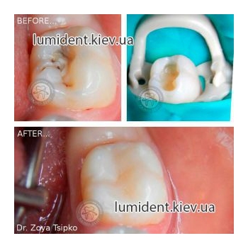 лечение зубов киев, фото, до и после