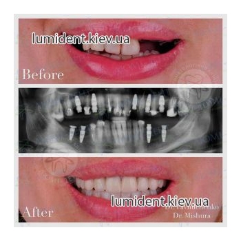 Протезирование зубов до после фото Люмидент