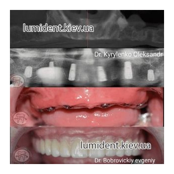 teeth impalnatation foto before after Ukraine Kiev Lumident