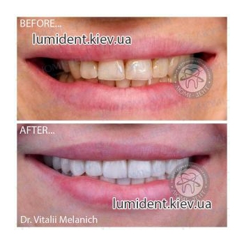 Протезирование зубов фото Люмидент