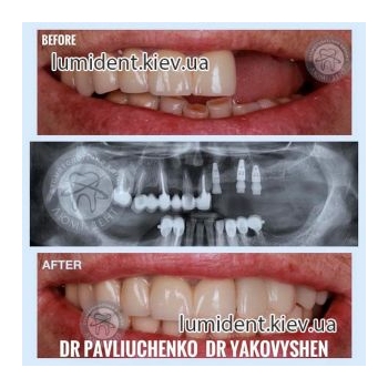 До и после протезирования зубов Люми-Дент