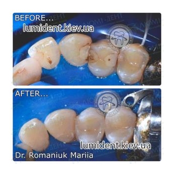 Фотография до и после пломбирования зубов Люмидент
