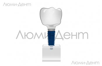 Види зубних імплантів Люмі-Дент фото