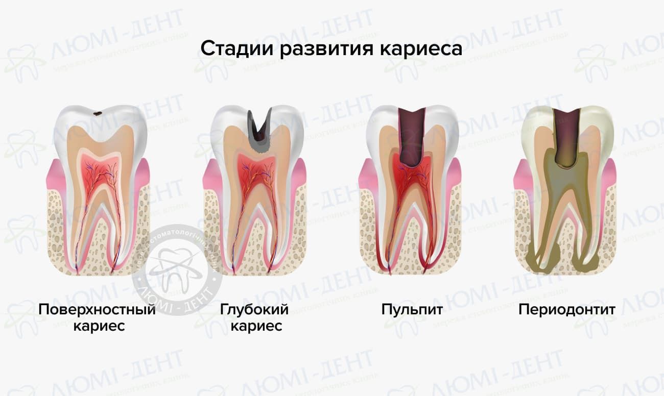 Почему болит зуб под пломбой после лечения кариеса