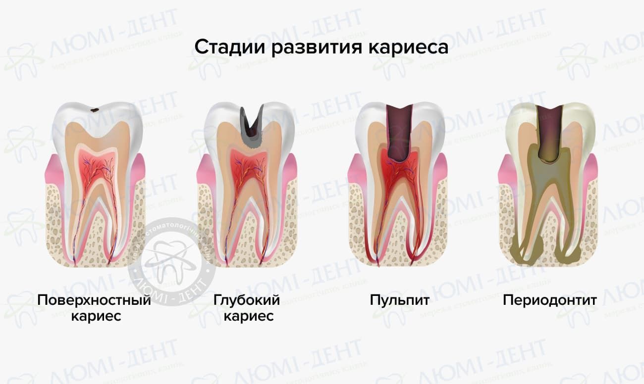 Почему болит зуб после лечения кариеса?