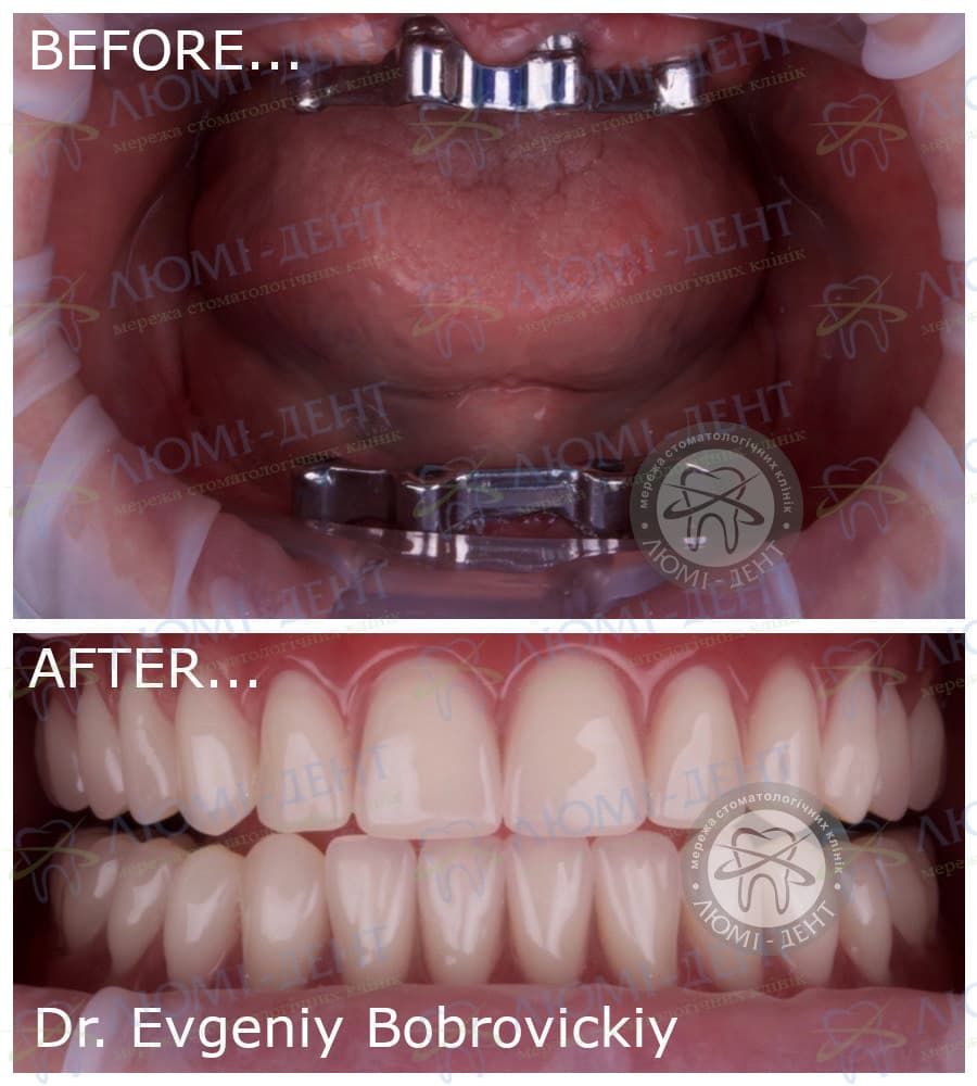 Зубна імплантація протезування фото Люми-дент