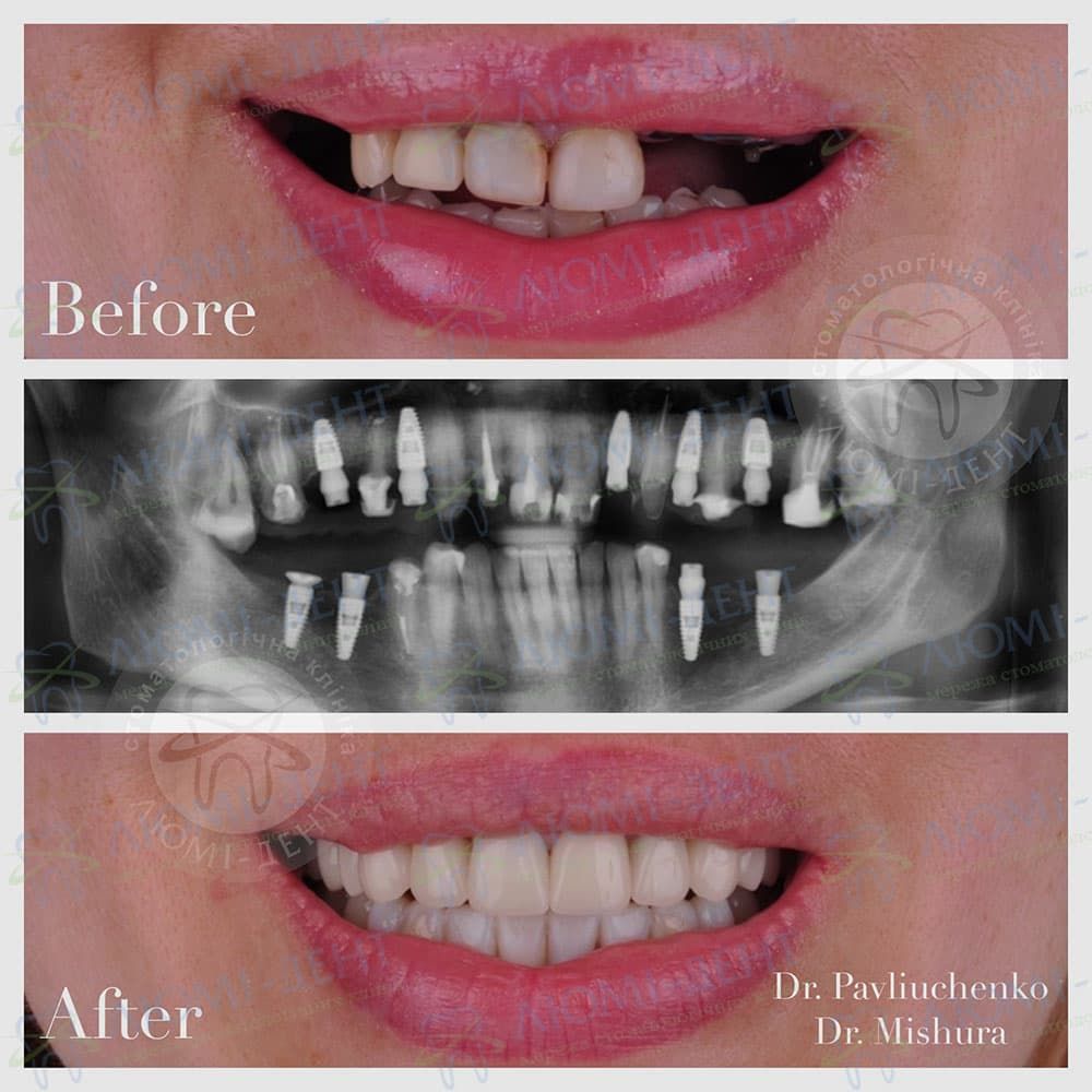 Протезування імплантація зубів фото Люми-Дент