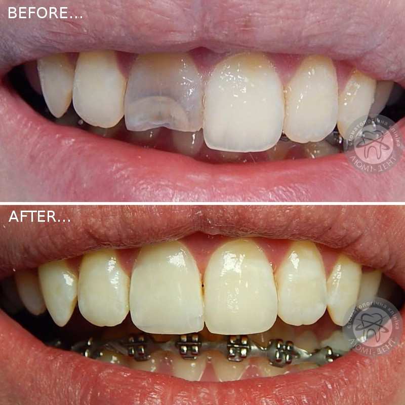реставрация зубов фото люми-дент