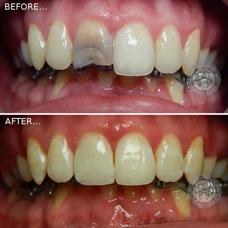 реставрация зубов фотографии люми-дент