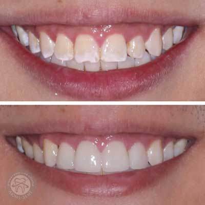 Восстановление эмали зубов фото Люми-Дент 