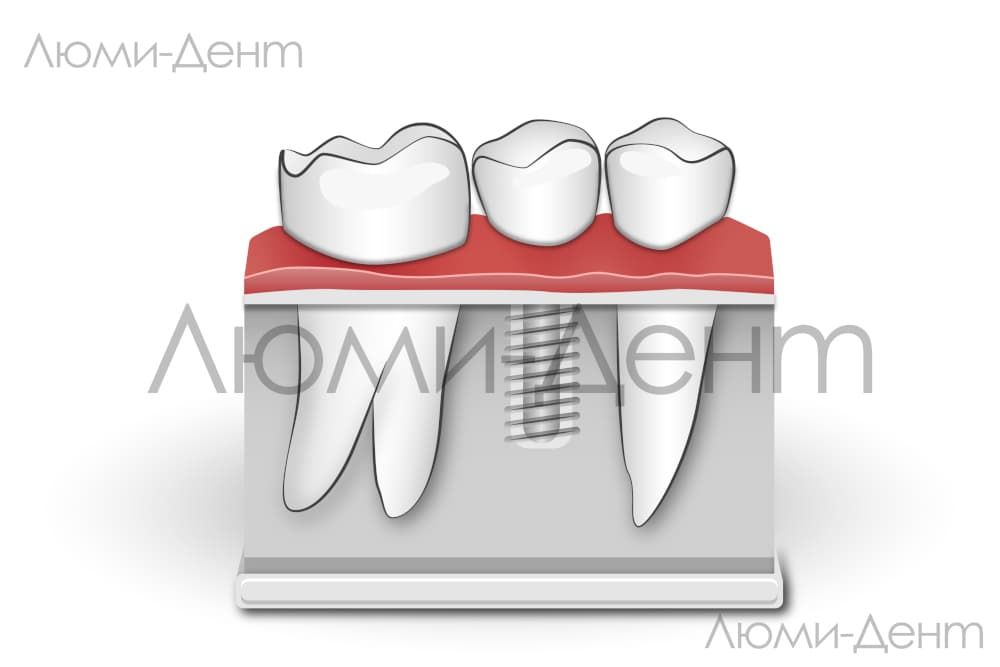 Коронки на зуби фото Люмі-Дент