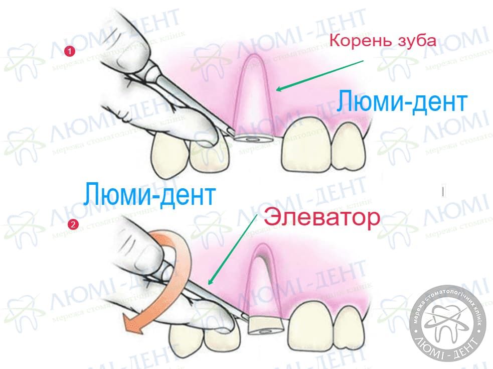 Методы восстановления зубов фото Люмидент