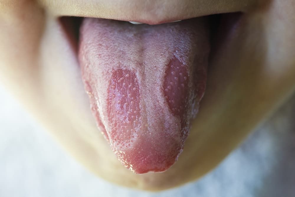 Кандидозний стоматит на язиці фото Люмі-Дент