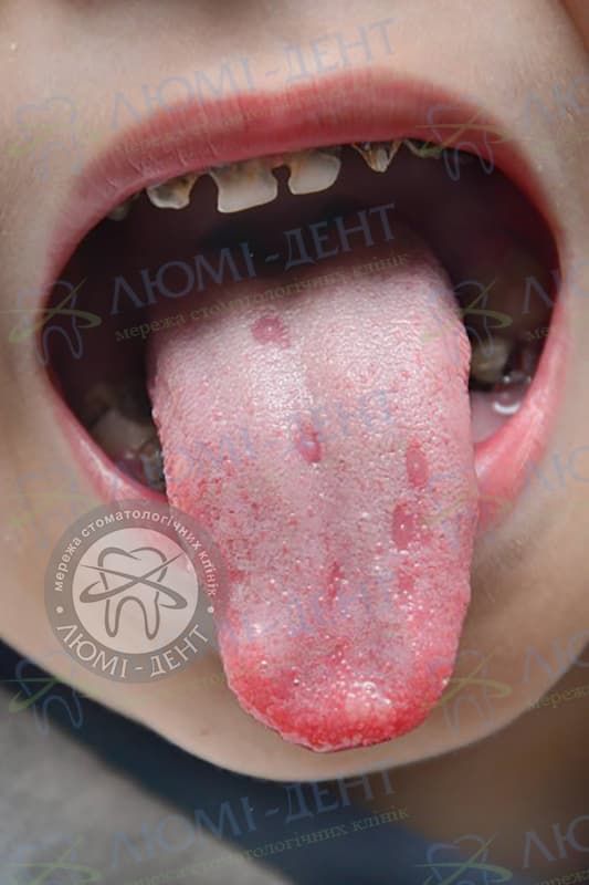 Вірусний стоматит на язиці фото Люмі-Дент