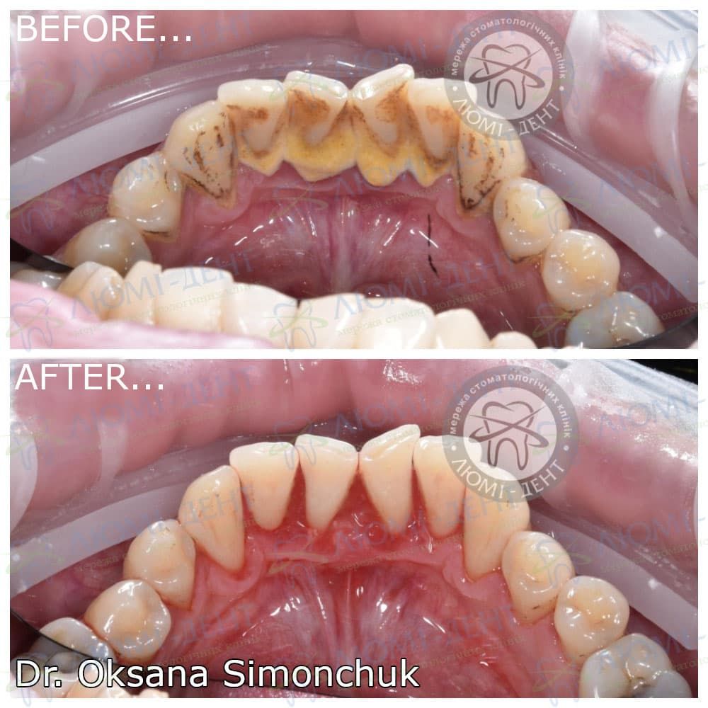 До и после чистки от зубных камней