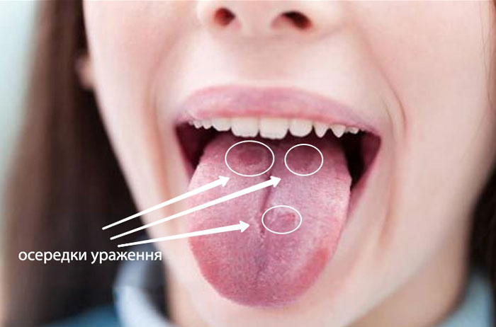 Стоматит у дорослого на язиці фото Люмі-Дент