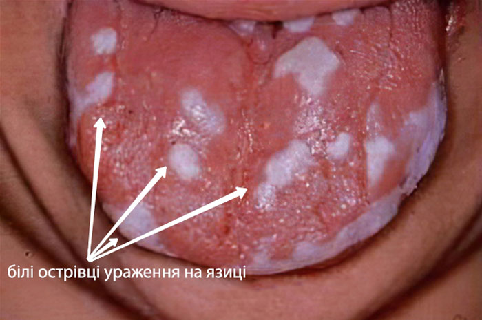 Кандидозний стоматит у дорослого фото Люмі-Дент