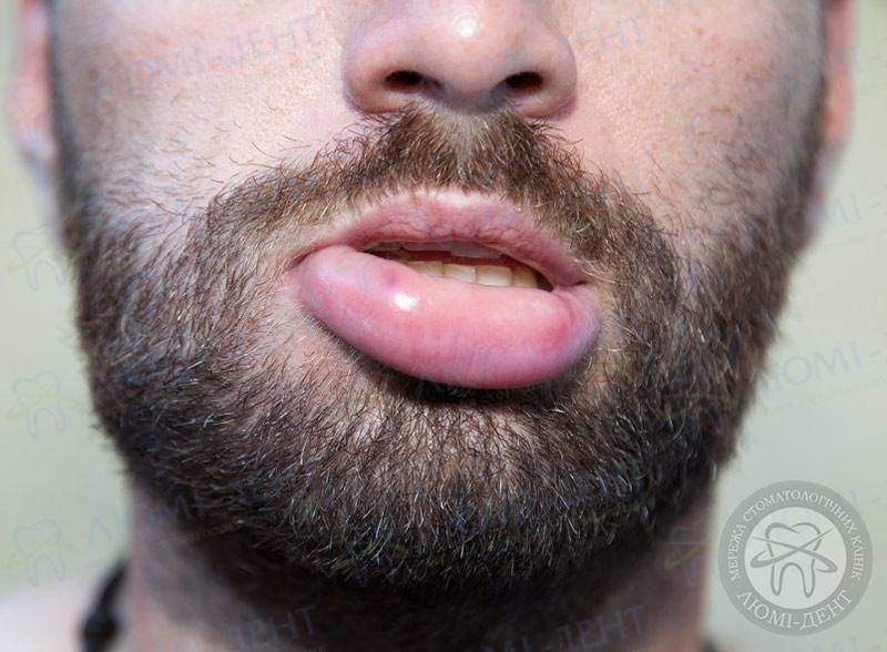 Почему может опухнуть верхняя губа: причины и лечение