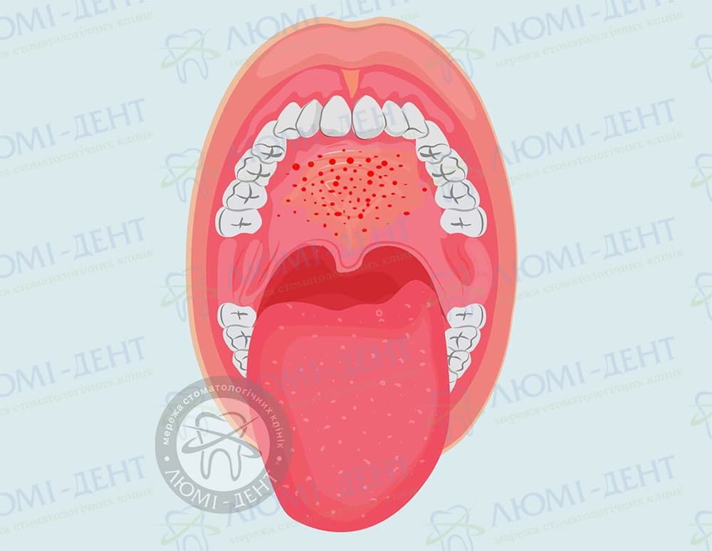Стоматит: лечение и симптомы у детей и взрослых - Клиника Лукашука