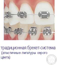 Традиційна брекет система Стандартні брекет системи