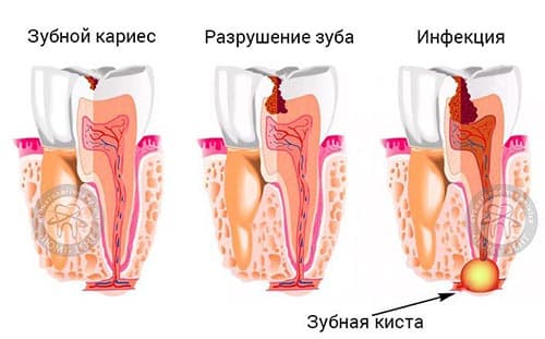 Зубная киста лечение фото Киев Люми-Дент
