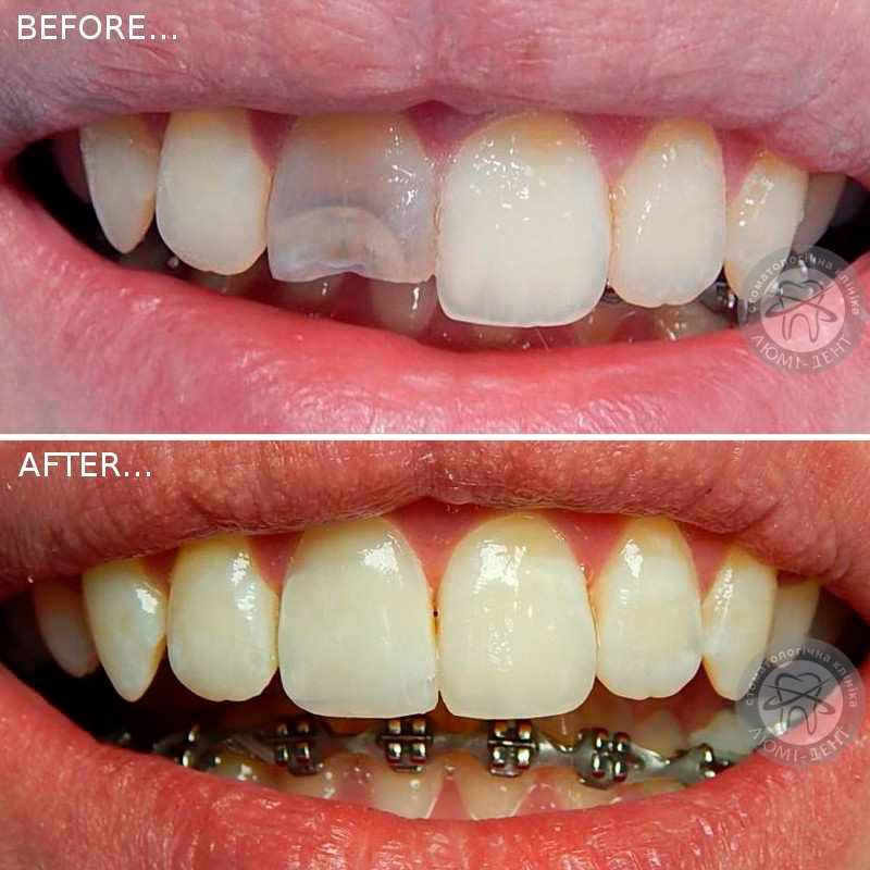 реставрація зубів київ фото люмідент