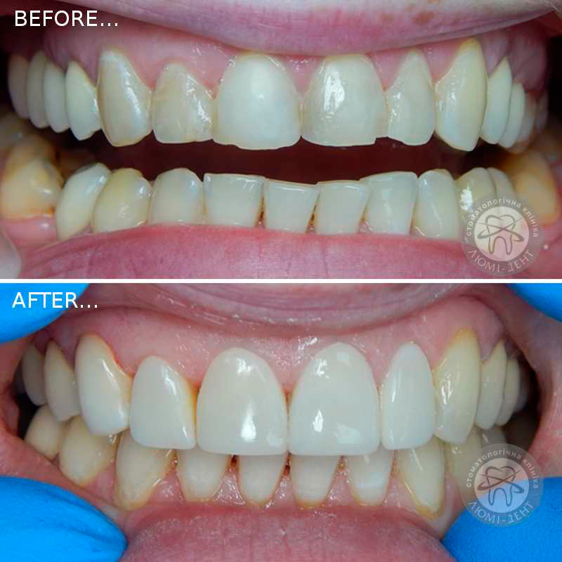 реставрация зубов