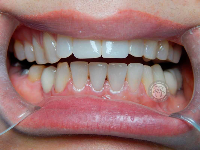 реставрація зубів